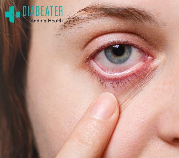 Dry eye treatment in Rewari